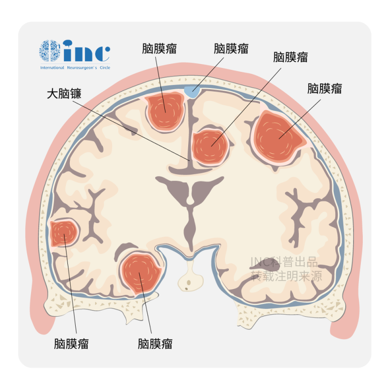 内镜下经鼻鞍区和鞍结节脑膜瘤手术：决策、技术和结果