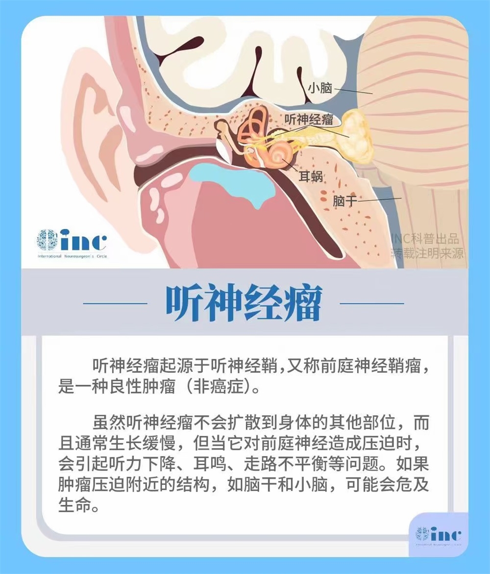 听神经瘤手术后遗症-1