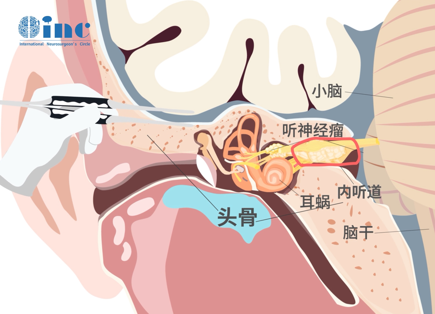 听神经瘤该手术还是保守治疗？该如何做治疗选择？