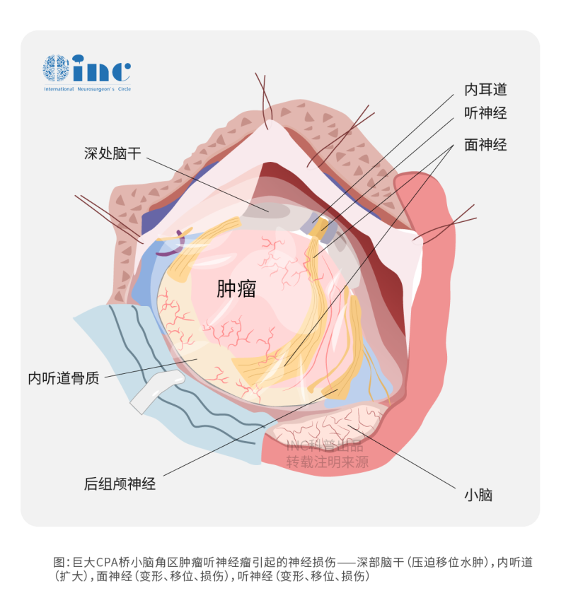 小脑角肿瘤和<a href='/bingzhong/tsjl/' target='_blank'><u>听神经瘤</u></a>的诊断误区