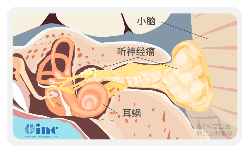 小脑角肿瘤怎么诊断