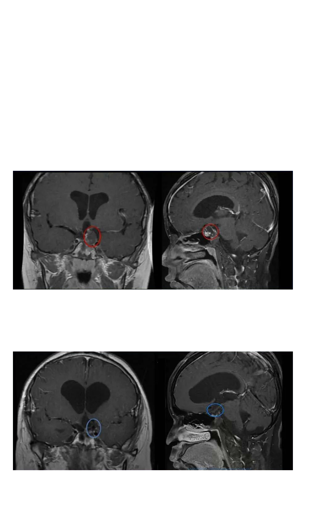 颅咽管瘤到底能不能全切2