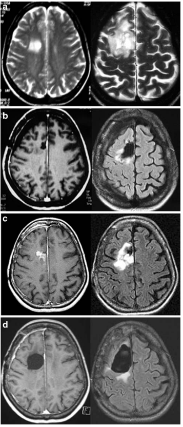 胶质瘤复发有必要二次手术吗