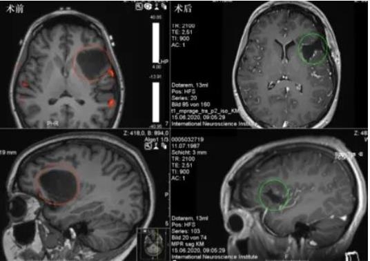 岛叶胶质瘤手术风险大吗