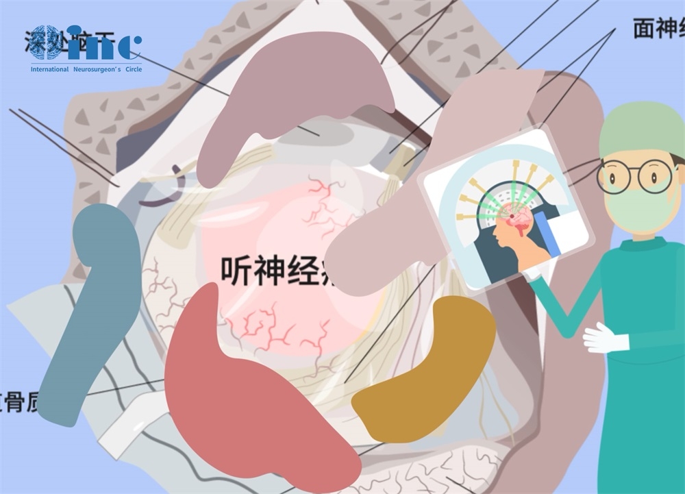 听神经瘤手术风险大吗？听神经瘤治疗预后受哪些因素影响？