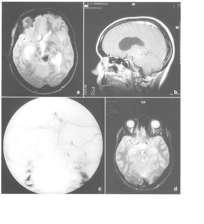松果体海绵状血管瘤怎么治？松果体海绵状血管瘤可以采用什么样的治疗策略