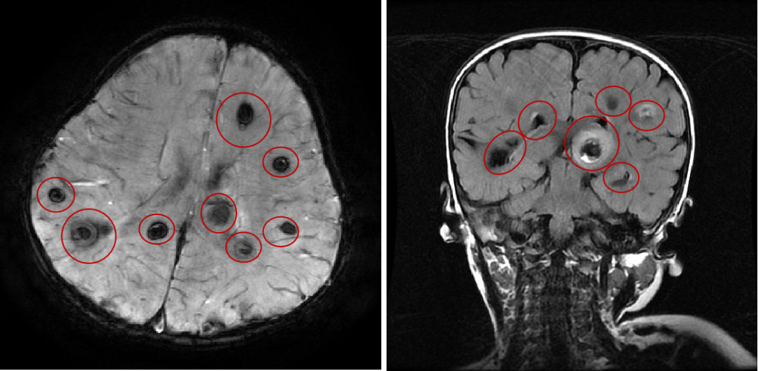多发性脑海绵状血管瘤能好吗？多发性脑海绵状血管瘤能很好的生活一辈子吗