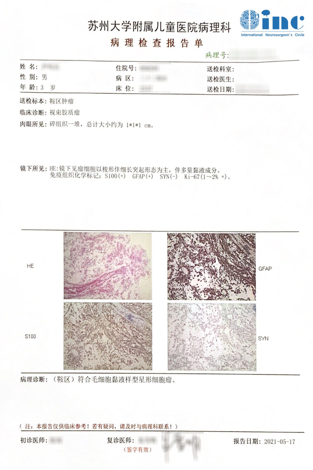 毛黏液样型星形细胞瘤诊断结果