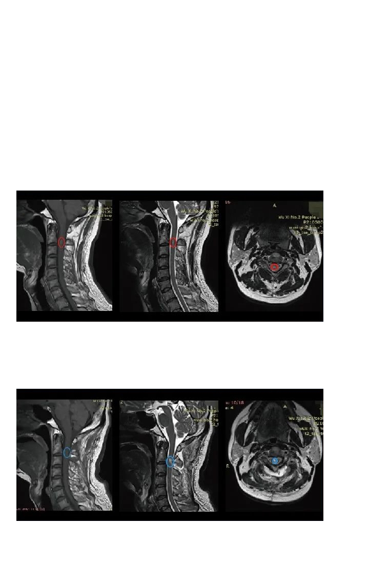 室管膜瘤能治愈吗