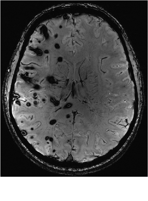 多发性脑海绵状血管的家族遗传性3