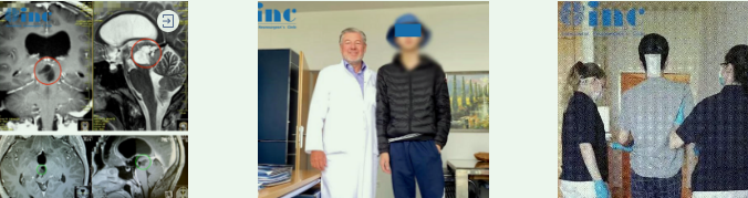 INC成功手术案例之中脑顶盖胶质瘤术后没有复发，考上名校