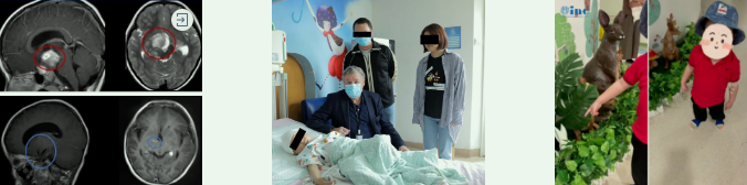 INC成功手术案例之较大视路胶质瘤“等待失明”，还是奋力一搏？