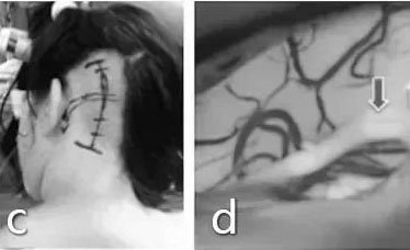 20岁花季女孩vs脑干“恶魔”：这场手术如何改写她的命运？