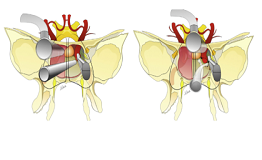 脊索瘤不开颅可以治吗？