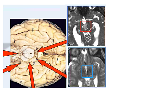 脑干海绵状血管瘤手术