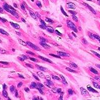 胶质瘤病理检查报告单揭示疾病本身哪些问题？