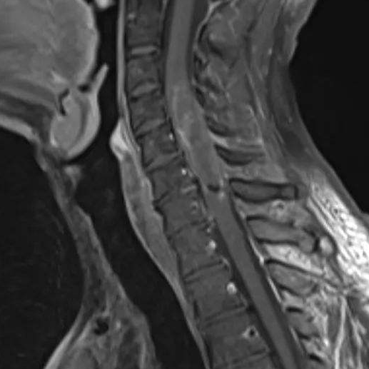 脊髓肿瘤术后需要注意哪些？