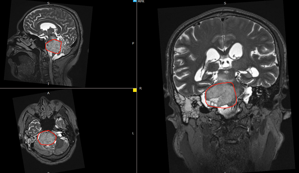 德国成功案例分享：58岁脑干胶质瘤，不想认命!