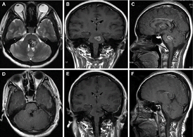 颅内海绵状血管瘤案例