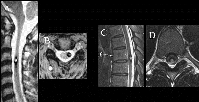 颅内海绵状血管瘤案例