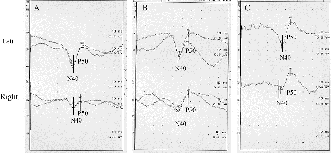颅内海绵状血管瘤