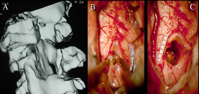 颅内海绵状血管瘤手术