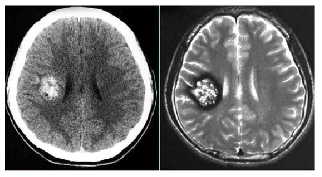 颅内海绵状血管瘤