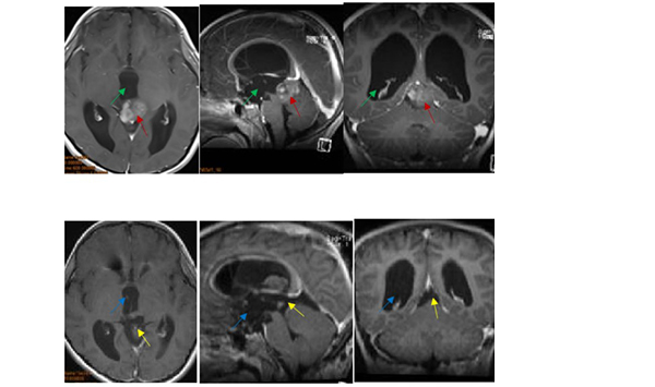 松果体区肿瘤案例