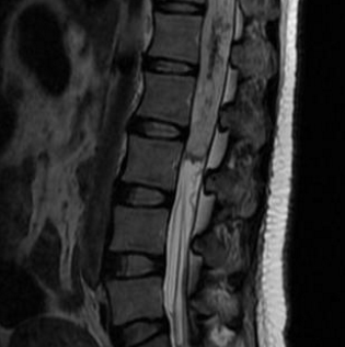 脊髓肿瘤是良性还是恶性？