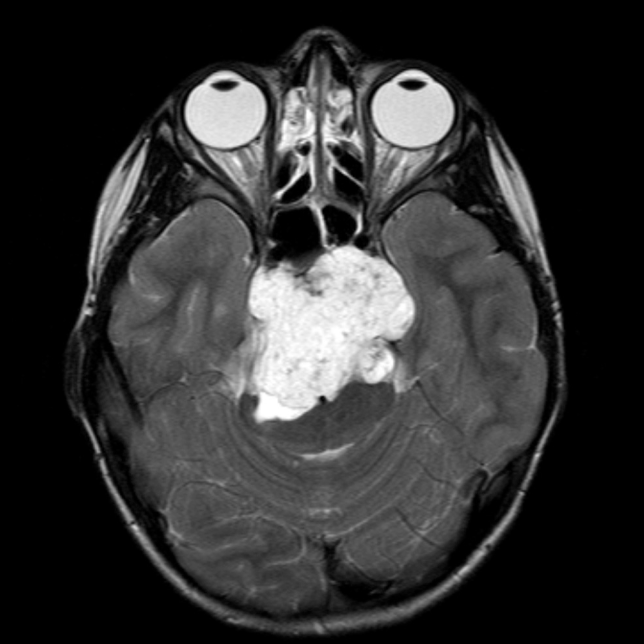 脊索瘤是良性还是恶性？