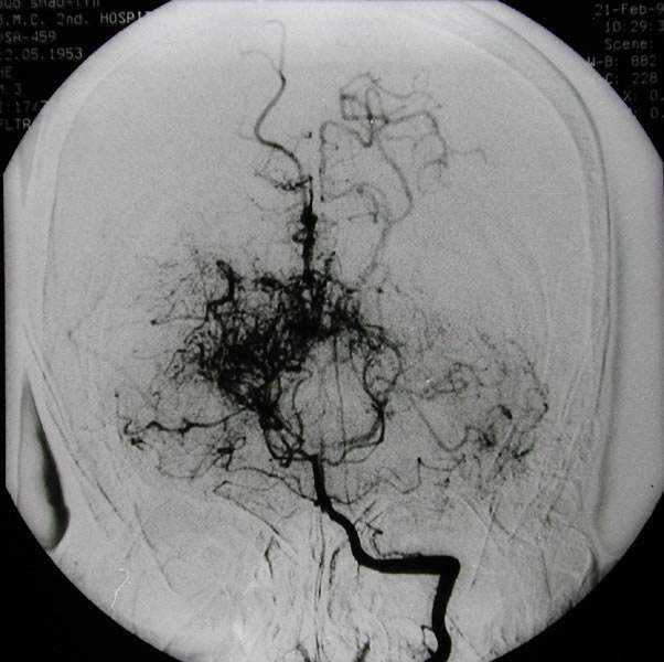 烟雾病能治好吗?生存率多高?