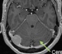 脑膜瘤是大手术吗?不同位置切除难度不一样