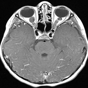髓母细胞瘤能活多久？加拿大Rutka教授详解国际治疗标准