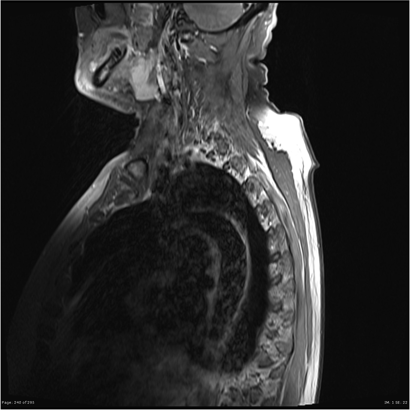 脊索瘤好发部位在哪里？