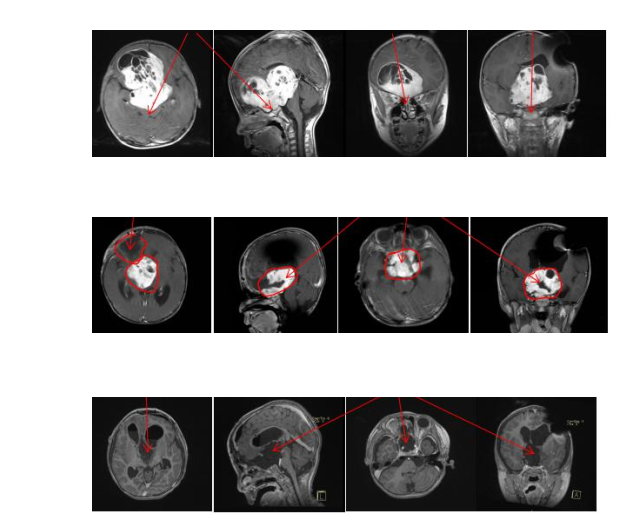 好发于儿童/青少年的视神经胶质瘤术后生存期多长？