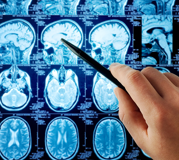 百万分之一发病率的脊索瘤是怎么回事？