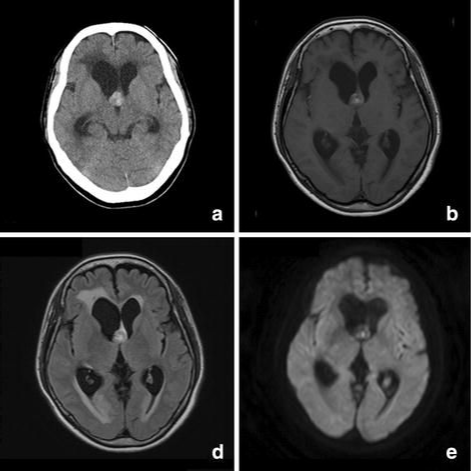 脑干海绵状血管瘤可以用微创手术治疗吗?