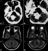 髓母细胞瘤钙化是什么意思