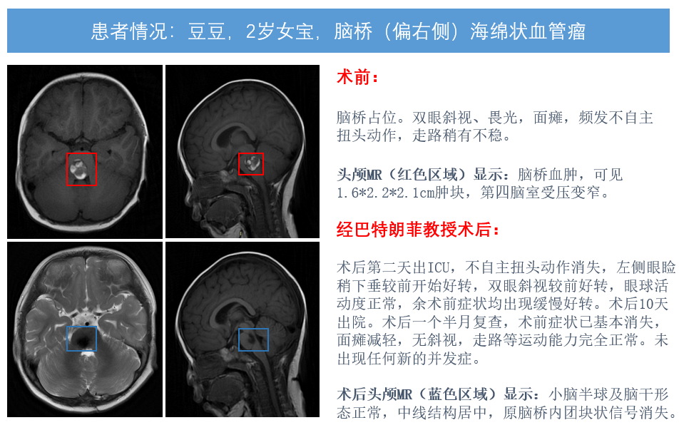 脑干海绵状血管瘤案例图片