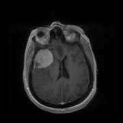 脑膜瘤严重吗？脑膜瘤好治吗？