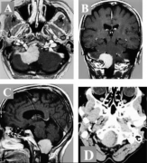 脑膜瘤治疗指南，脑膜瘤治疗方法有几种?