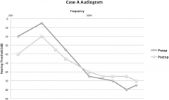 听神经瘤治疗需开颅手术吗？
