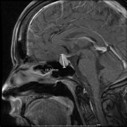 垂体瘤严重吗？有哪些垂体瘤治疗方法？