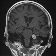听神经瘤是怎么形成的？有哪些症状