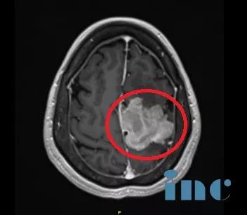 颅内巨大脑膜瘤案例图片4