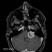 听神经瘤是大手术吗？听神经瘤手术后恢复期详述