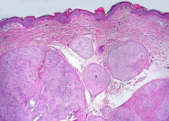 听神经瘤的主要临床表现有哪些？听神经瘤怎么治疗好？