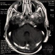 国外听神经瘤优选治疗方法有哪些？听神经瘤手术要点分析