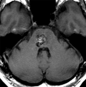 问：如果没有症状，脑海绵状血管瘤不用治疗吗？