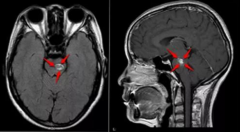脑干海绵状血管瘤出血手术治疗的较佳时间